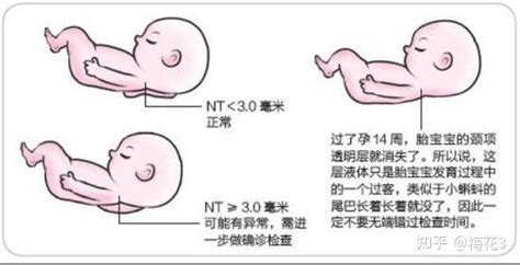 关于怀孕检查NT的一些事情 - 知乎