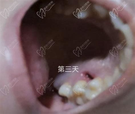 拔牙5天后牙窝愈合过程图，经过多长时间才能完全愈合呢？_皓齿口腔网