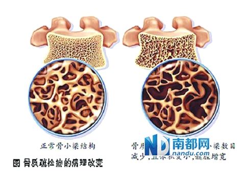 骨小梁示意图图片