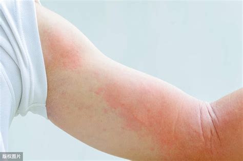 慢性荨麻疹怎么调理_健康讲堂_大成皮肤网