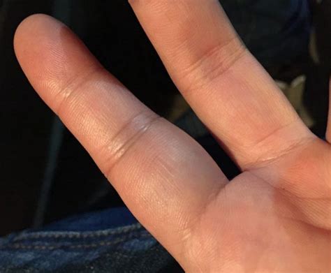 手指肿大竟查出肺癌？手的这些异样，可能是大病警告