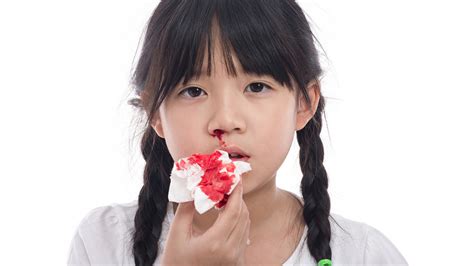小儿鼻出血的原因 - 专家文章 - 复禾健康