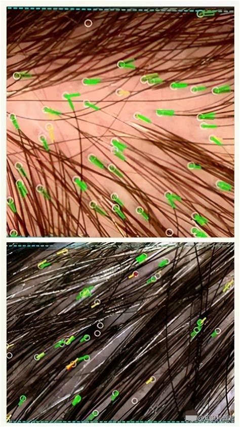 治疗脱发有望，毛囊干细胞代谢里的秘密