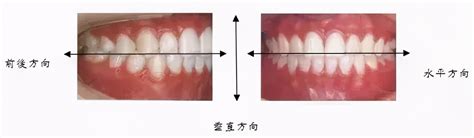 正常人牙齿闭合的样子图片，怎样判断牙齿咬合功能是否正常_深圳爱康健口腔医院官网