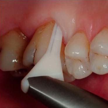 Neboleče odstranjevanje zobnih oblog z aparatom Air-Flow Handy Perio | ZoboEstetika d.o.o.
