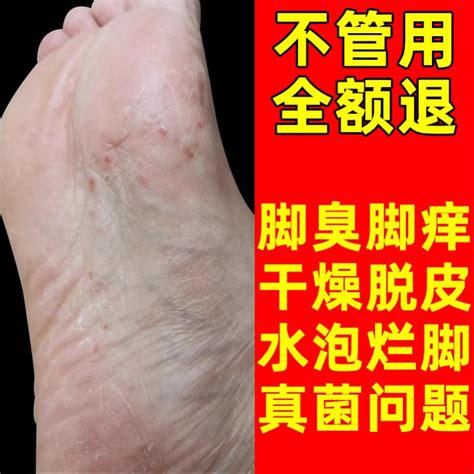 脚癣脚底脚干裂脱皮真菌感染脚气日本脚上脚藓脚后跟手脚开裂药膏_虎窝淘