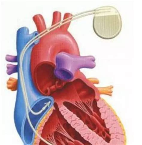 安装心脏起搏器图片,类型,正常_大山谷图库