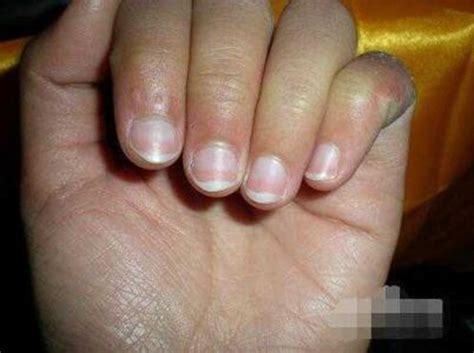 两手指灰指甲的初期症状图片_有来医生