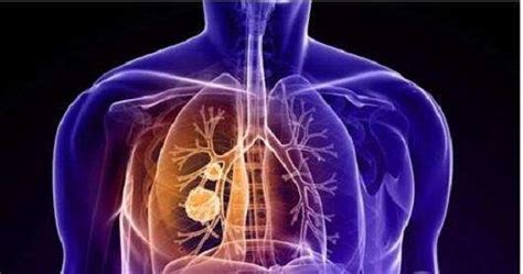 什么是肺结节？它和肺癌是“亲戚”吗？|肺结节|肺结核|症状|病因|-健康界