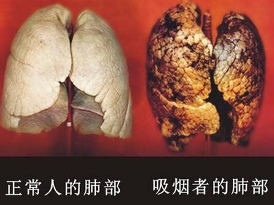 吸烟者的肺图片