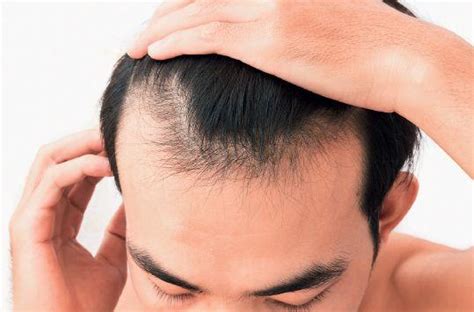 脱发是什么原因 治疗脱发的最好方法_湖南频道_凤凰网