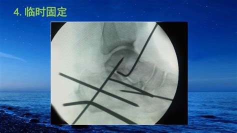 跟骨骨折如何治疗？看完这篇你就会啦