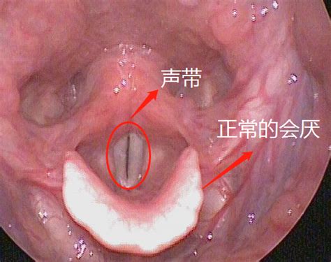 喉咙正常图片