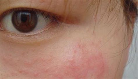 痒痒痒，夏季皮炎高发，皮肤科告诉你为什么|夏季皮炎|皮炎|抗生素_新浪新闻