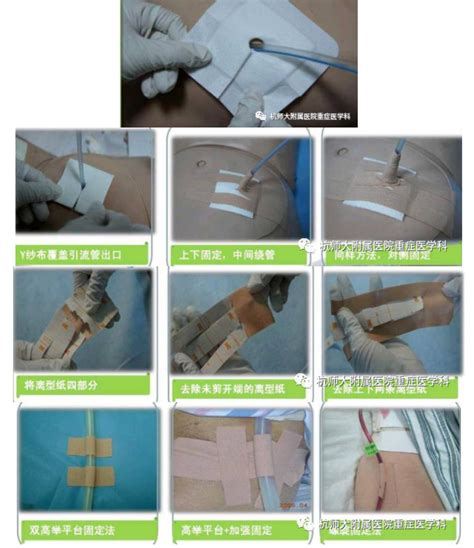封开县中医院成功实施CT引导下肝脓肿穿刺引流术_腾讯视频