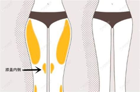从大腿环吸的8个部位图解来看，包括臀线、胯骨和膝盖内侧抽脂吗整形案例 - 丹东富雅华医医疗美容诊所 - 炫美网