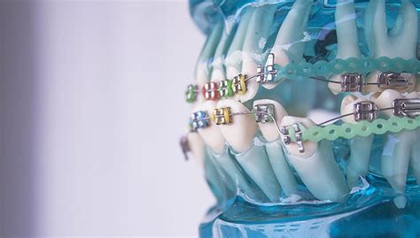 可乐牙后续戴牙效果左上2瓷贴面备牙-青岛牙医 王文泽的博客-KQ88口腔博客