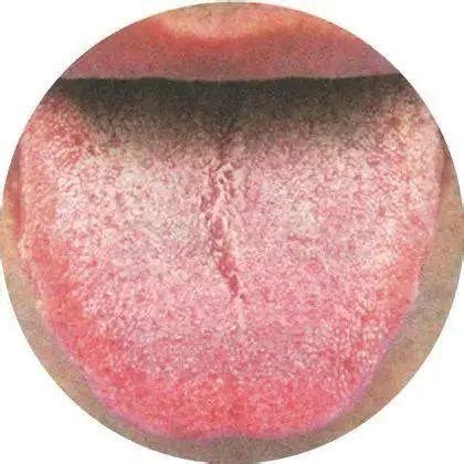 舌头中间有裂纹是怎么回事？中医认为是脾虚，教你1招来解决 - 知乎