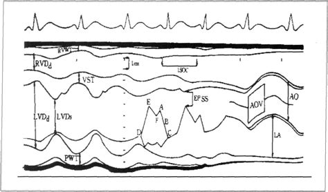 三、正常心脏M型超声心动图与各参数的测量标准-心血管-医学