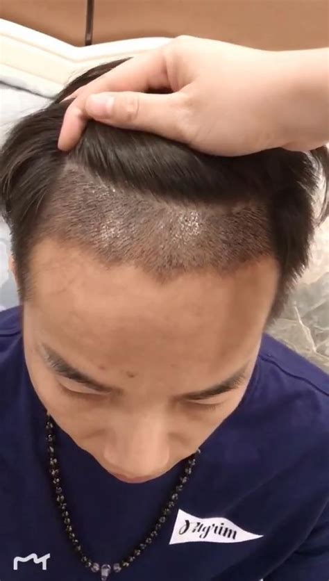 头发种植后需要多久才能恢复？ - 知乎