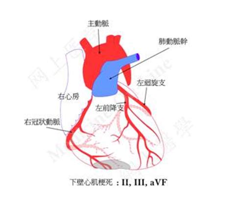 心脏病发作（心肌梗塞）：症状、发病原因、治疗和预防 - 知乎
