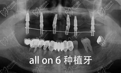 半口缺牙烦恼多？数字化亲骨种牙，助力好牙好口福——广州德伦口腔