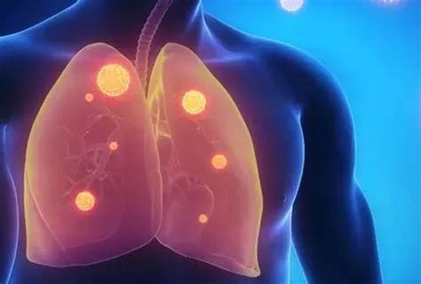 肺癌晚期三个征兆都是怎样的？肺癌有哪些类型-盛诺一家