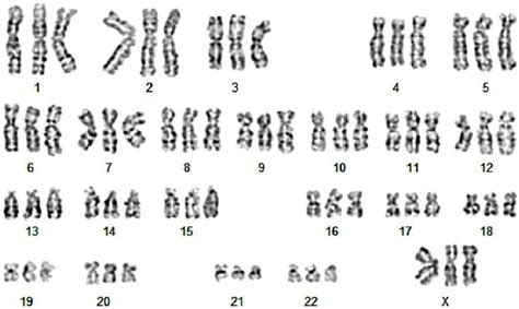 -The karyotypes of the second fetus with cystic hygroma -69XXX ...