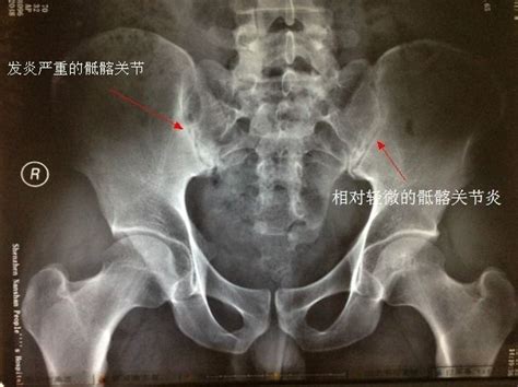 骶髂关节位置图图片
