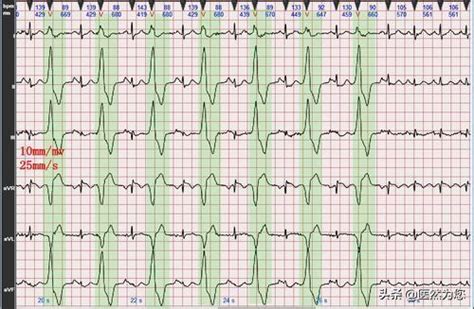 如何做好有创动脉血压监测及其波形分析？史上最详细的解读来了！