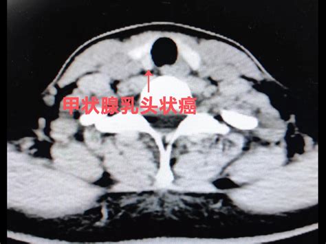 甲状腺结核伴甲状腺乳头状微小癌 18 F－FDG PET/CT显像1例