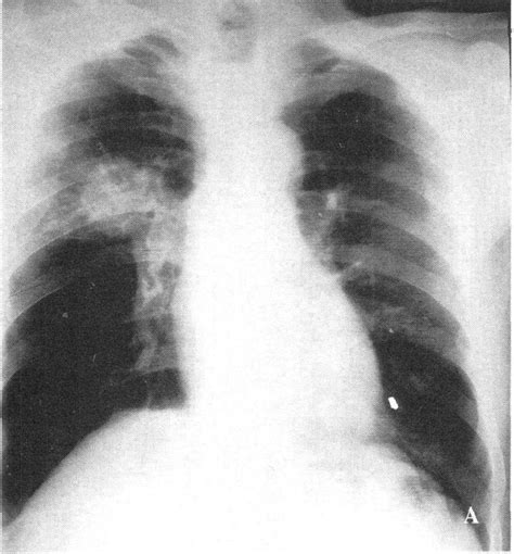 图2—204 小细胞低分化型肺癌-胸部X线影像学图鉴-医学
