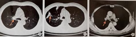 揭秘 “肺鳞癌” 特点以及如何选择最佳检测和治疗方案？|肺鳞癌|肺癌|癌细胞_新浪新闻