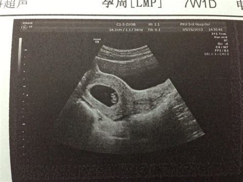 怀孕4个月b超单子照片