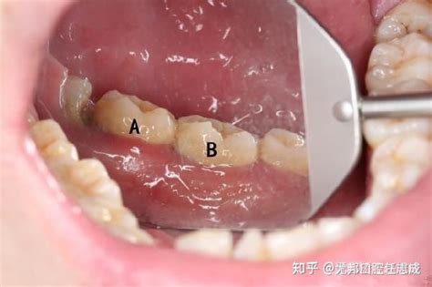假牙边缘和牙龈有缝隙