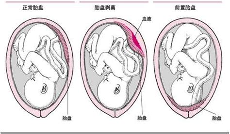 胎盘后置胎盘下缘达到宫颈口内
