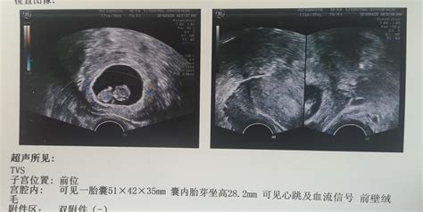 13周的胎儿b超图片