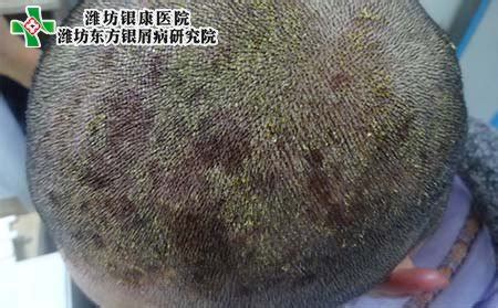 头皮银屑病