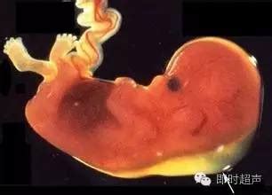 14周胎儿nt图片