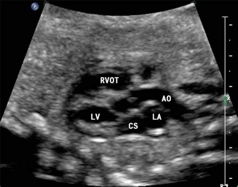 考虑胎儿永存左上腔静脉是什么意思