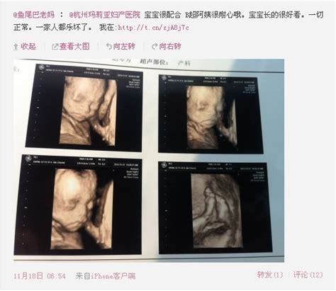 16周能照四维彩超吗