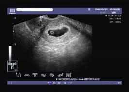 怀孕37天b超能看见孕囊吗