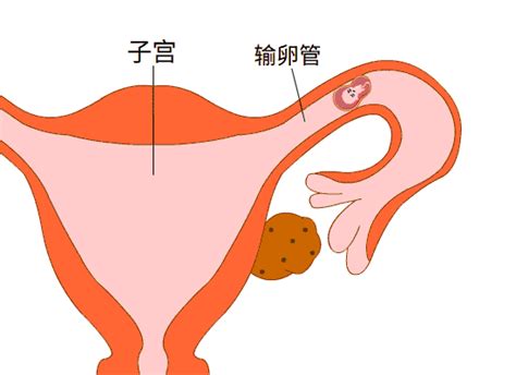 输卵管囊肿的症状是什么