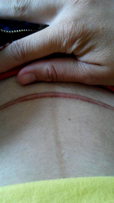 剖腹产疤痕能去掉吗