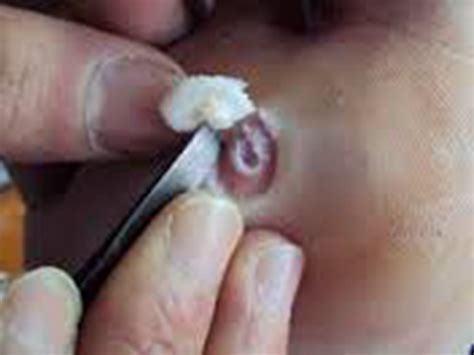 婴儿胼胝体发育不全能活多久