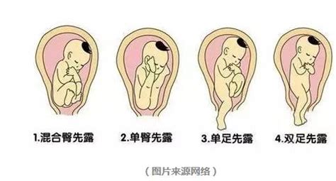 单臀位矫正方法