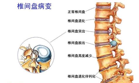 有治腰间盘突出的秘方吗?