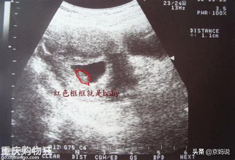 怀孕11周自测胎心方法