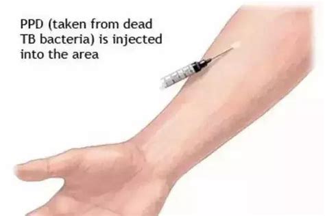 35周了还用打促肺针吗
