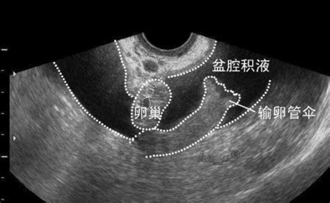 盆腔积液可以跑步吗?